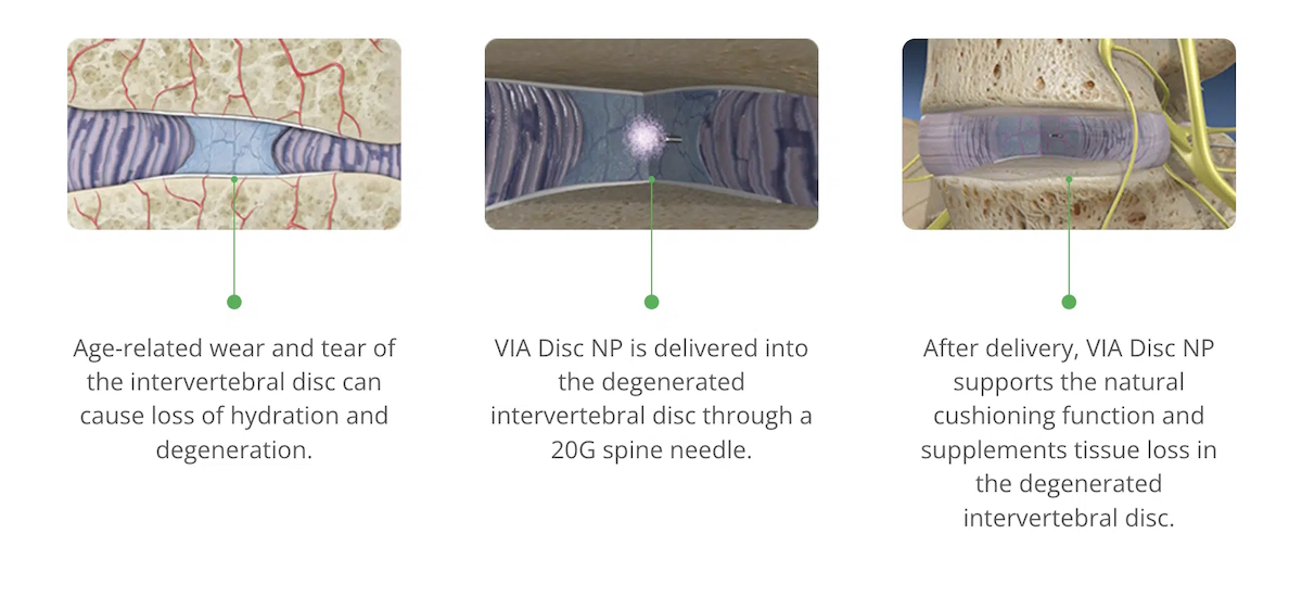 VIA Disc NP medical illustration viadiscnp com