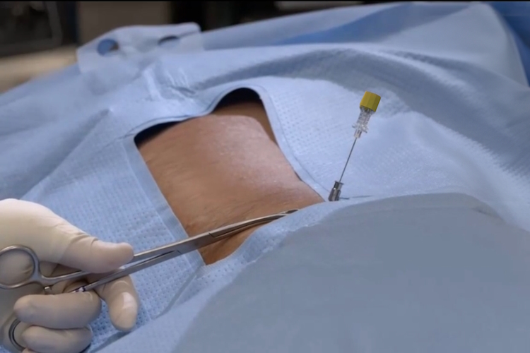 procedures pain treatment via disc np injection viadiscnp com procedures pain treatment via disc np injection viadiscnp com